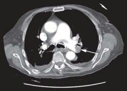 Left Main Pulmonary Artery