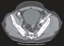 Distal Left Ureter Stone