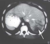 Liver Laceration on Contrast Enhanced CT Scan