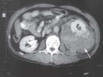 Left Renal Fracture with Associated Hematoma