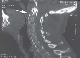 CT Sagittal Reconstruction of type 2 Odontoid Cervical Fracture