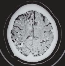 Contrast CT scan