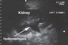 Anechoic Area Hydronephrosis