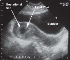 Gestational Sac and Fetal Pole