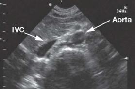 View of the Aorta