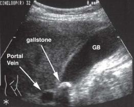 Gallstone at the neck of the Gallbladder