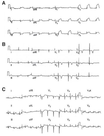 EKG Findings in Acute Coronary Syndromes