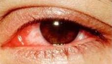 The Red Eye